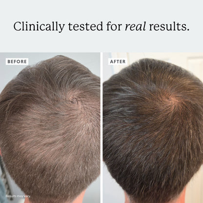 3-in-1 Hair Growth Bundle: Gummies