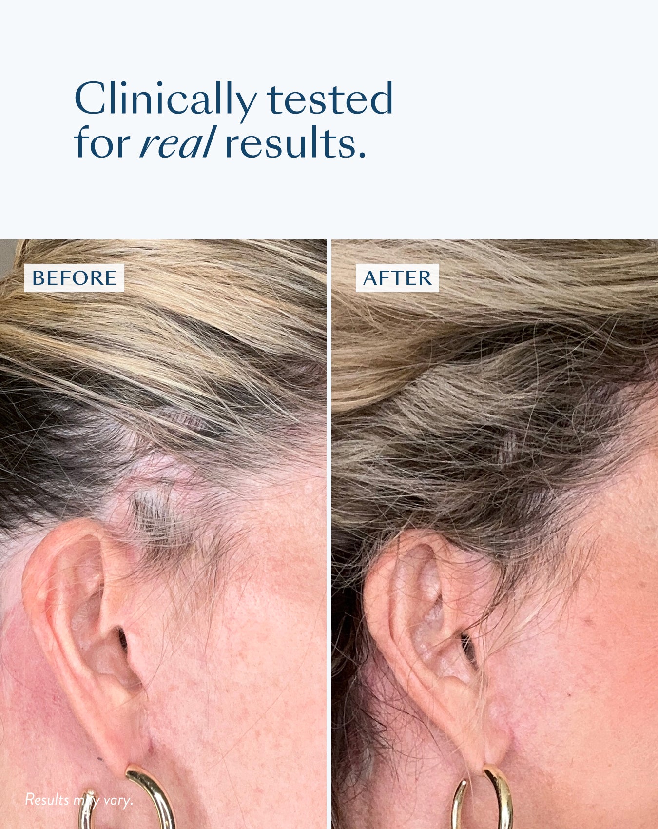 Before and after: a woman’s thinning hairline at the temple, visibly fuller after using eSalon hair growth products